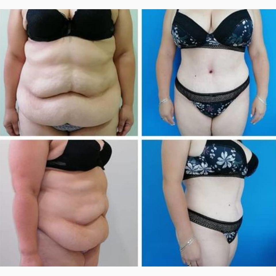 Dr. Jairo Zalamea Silva - Cirugía Plástica