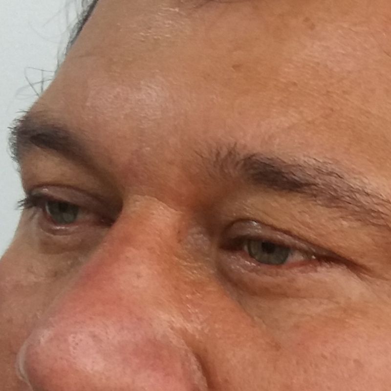 Blefaroplastia