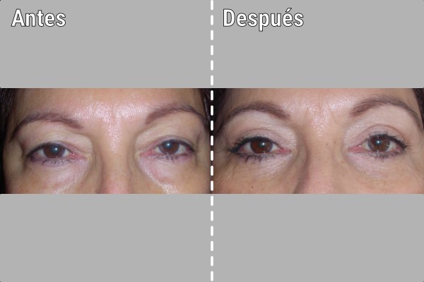 blefaroplastia
