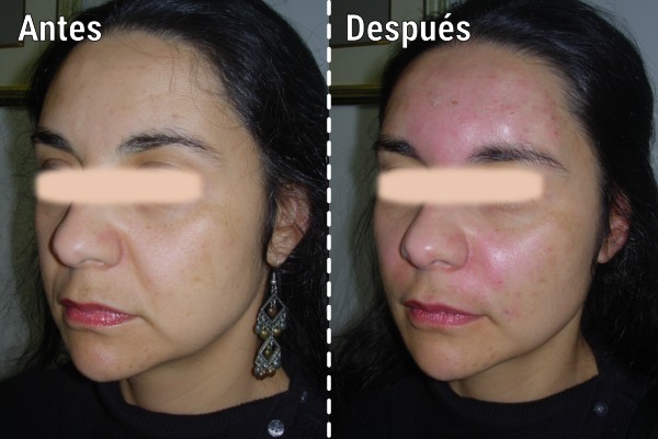 lipoinyeccion-facial