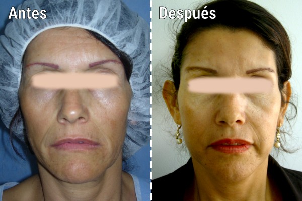 lipoinyeccion-facial