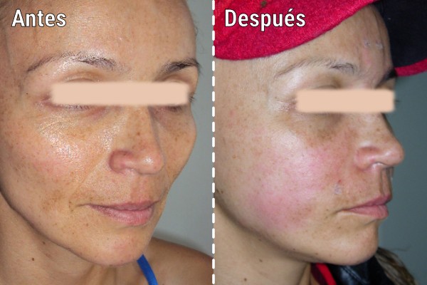 lipoinyeccion-facial