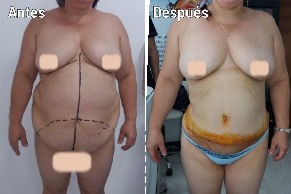 lipoescultura-liposuccion