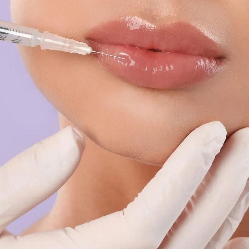 lipoinyeccion-facial