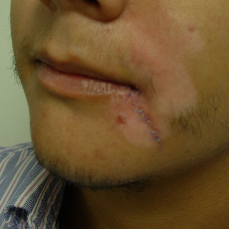 Reconstrucción de lesiones