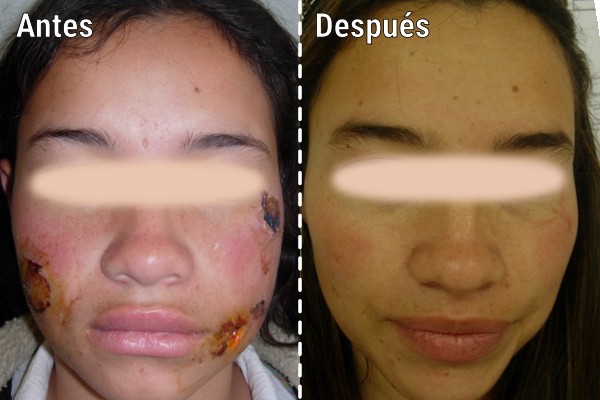 reconstruccion-de-lesiones