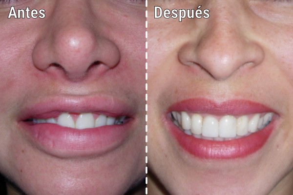 tratamiento-quirurgico-por-biopolimeros